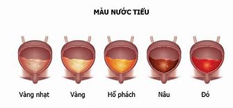 Nước Tiểu Có Màu Cam Nhạt Là Bệnh Gì